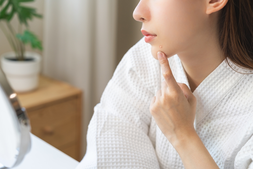 大人ニキビができる原因