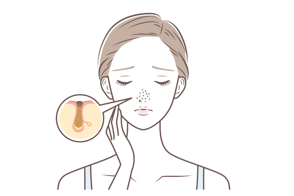 鼻の角栓に悩む女性のイメージ